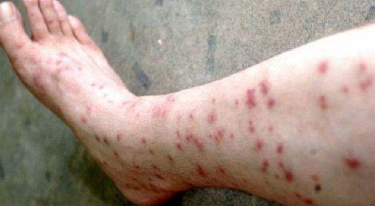 В Кирилловке морские блохи загрызают людей: страшные последствия для детей и аллергиков